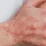 Atopická dermatitída