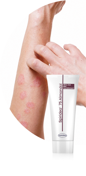 Atopická dermatitída